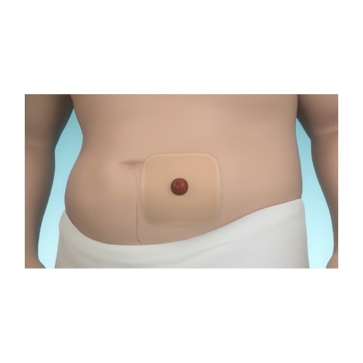 Placa Protetora para pele Periestoma - 10x10 - Brava - Coloplast Placa Protetora para pele Periestoma - 10x10 - Brava - Coloplast